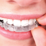 How Invisalign Adapts to Complex Bite Corrections and Dental Challenges
