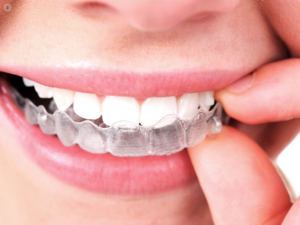 How Invisalign Adapts to Complex Bite Corrections and Dental Challenges